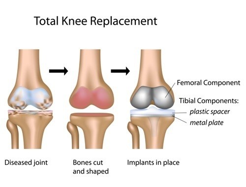 total knee replacement