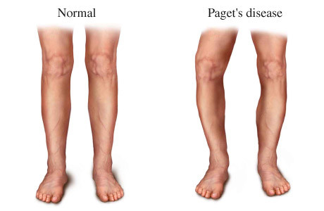 Paget’s disease