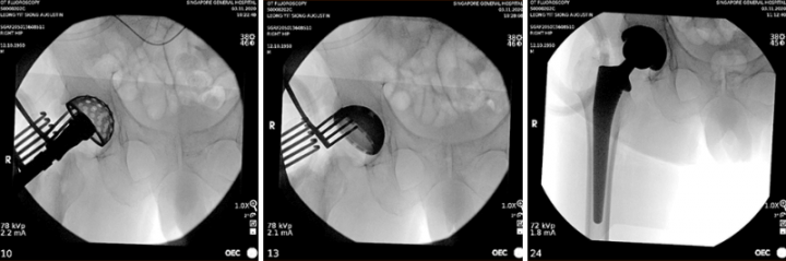 intraoperative scan combined hip replacement surgery