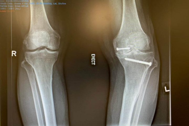 xray left knee before surgery