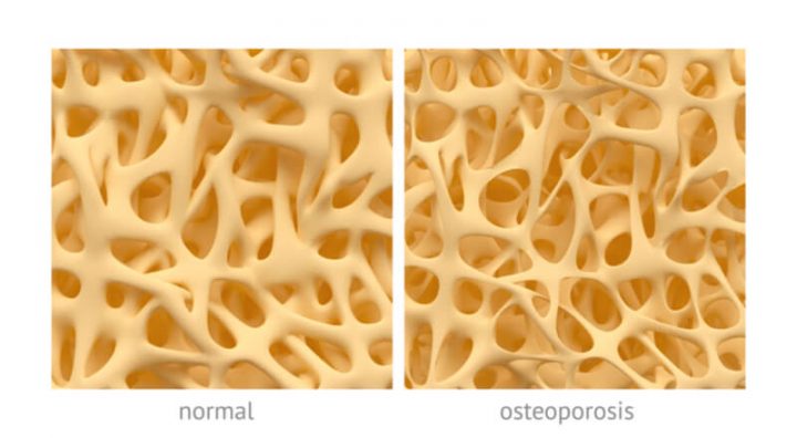 osteoporosis bone health problems